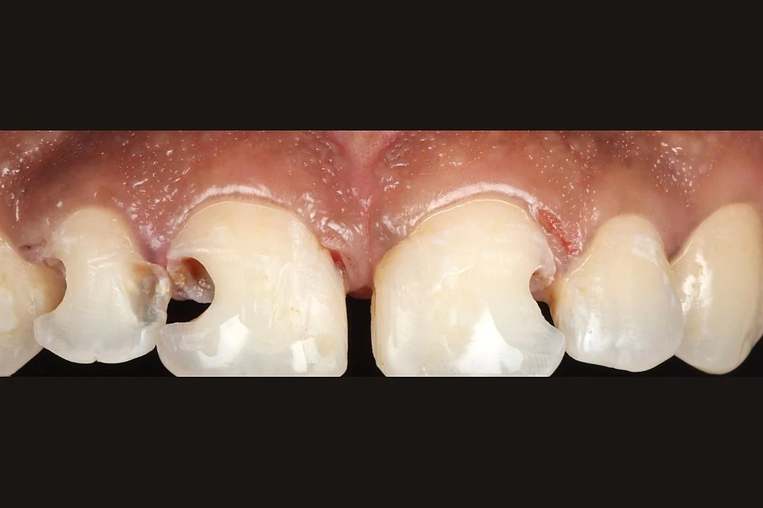 Clinical photograph of patient case 1 before treatment at SmileWorks Dental Studio