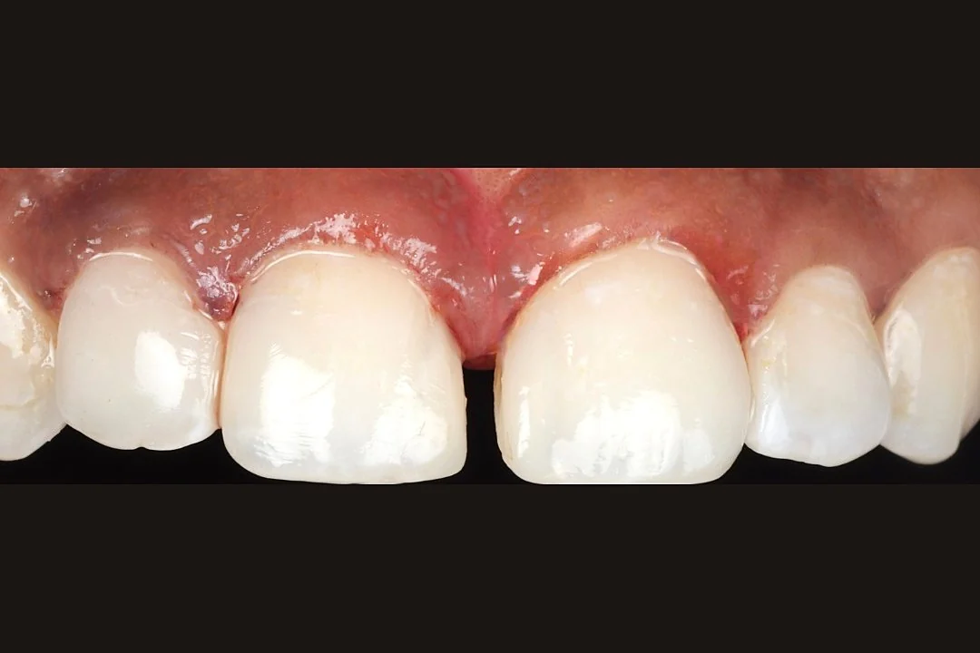 Clinical photograph of patient case 1 after treatment at SmileWorks Dental Studio